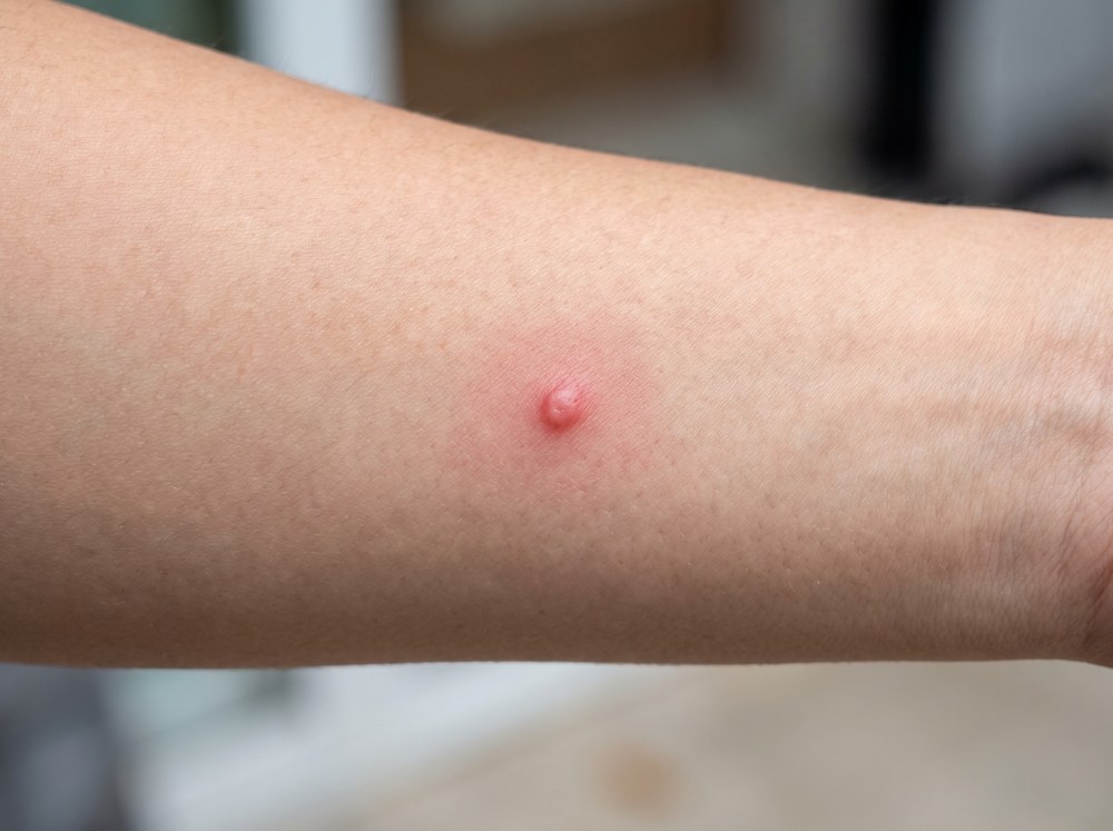 Close-up photo of mild red skin irritation on a forearm caused by contact with a stink bug's defensive secretion